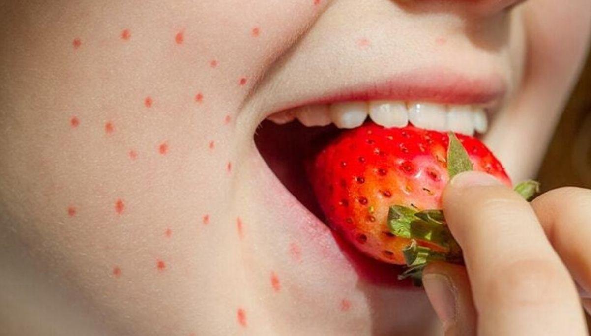 علایم حساسیت به توت فرنگی