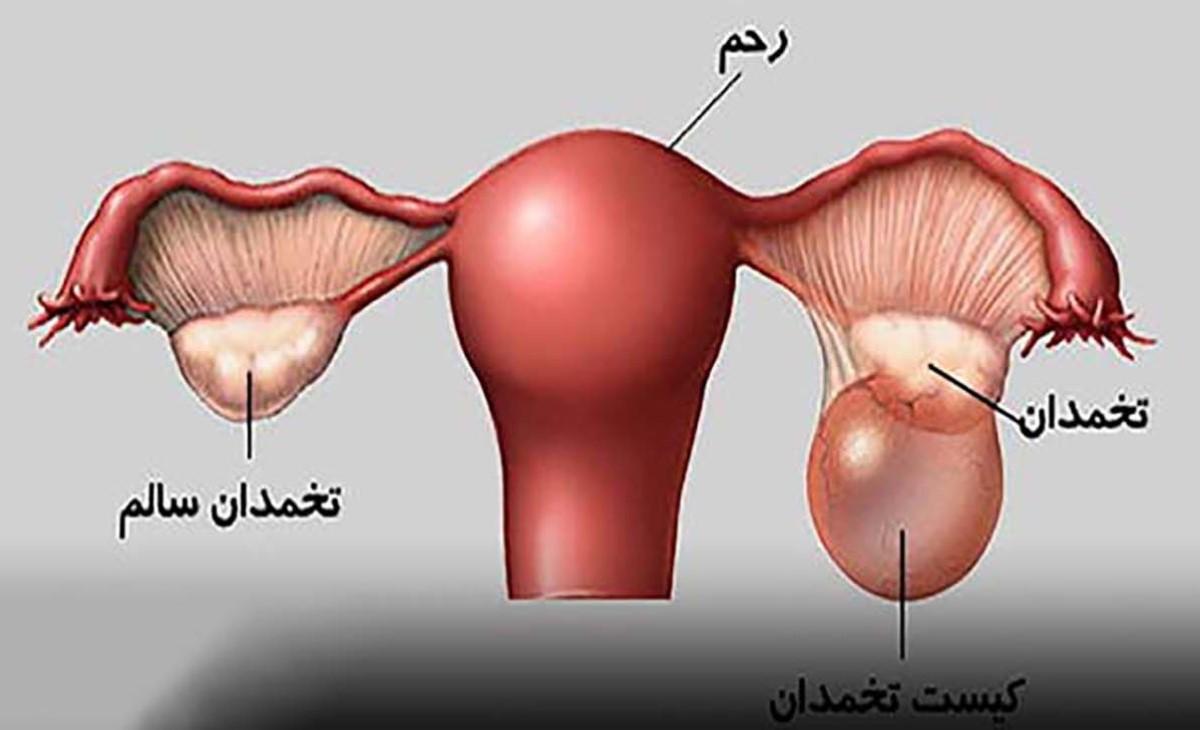 درمان کیست تخمدان با پابند طلا