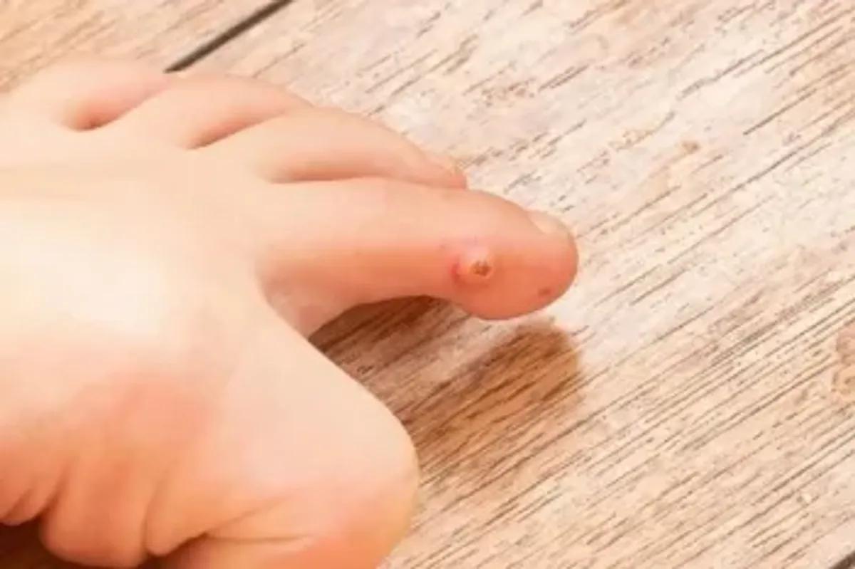 تکنولوژی سرما در خدمت زیبایی پوست |  کرایوتراپی، روشی مدرن برای حذف میخچه و زوائد