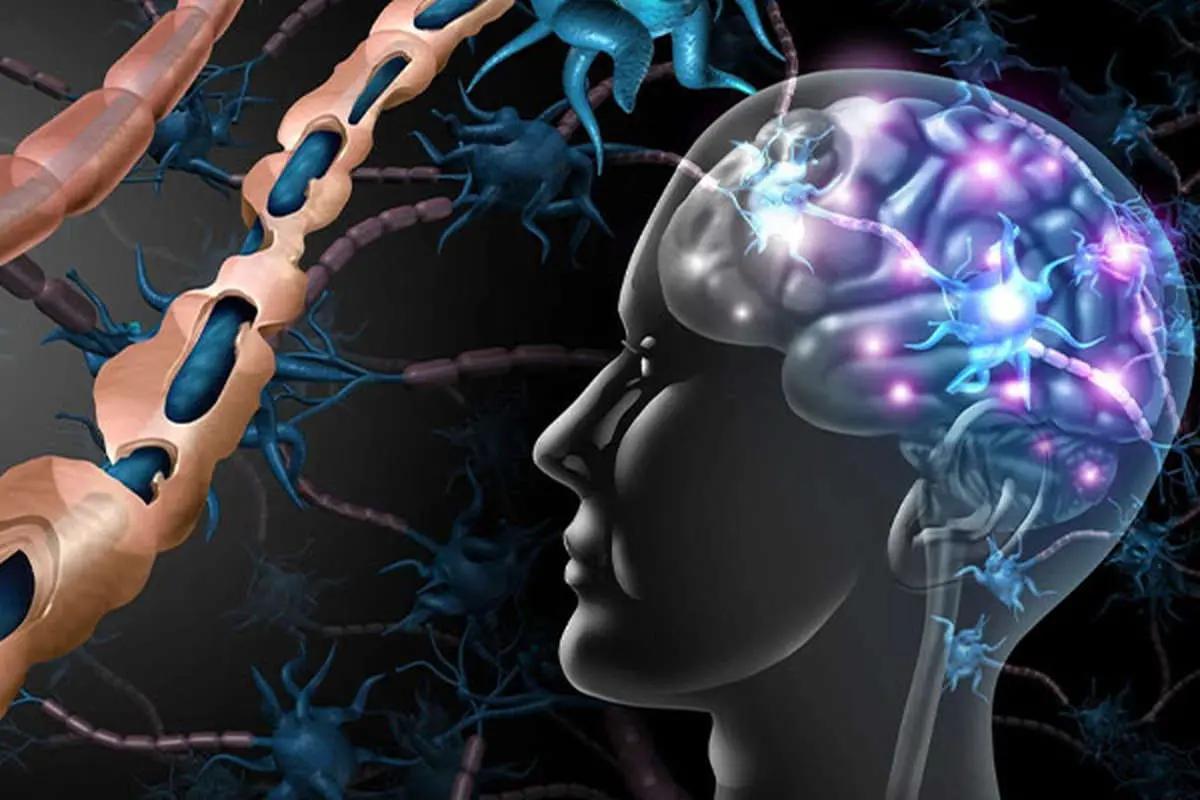 ام‌اس در زنان ۲ برابر بیشتر از مردان