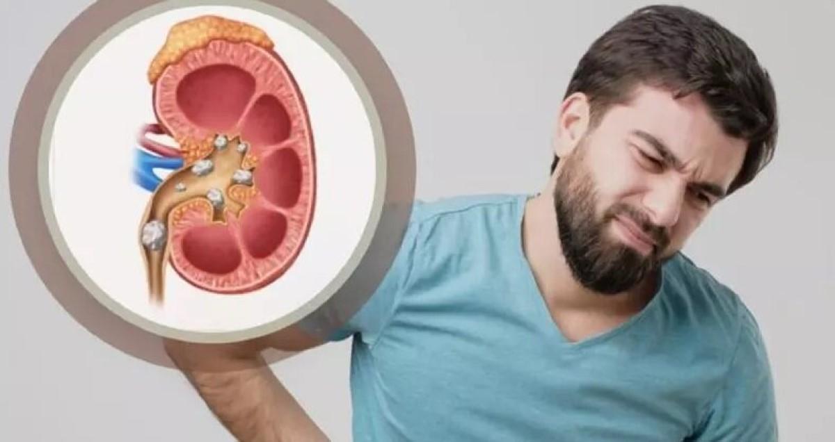 دفع بدون درد سنگ کلیه با رب تخم گل نسترن