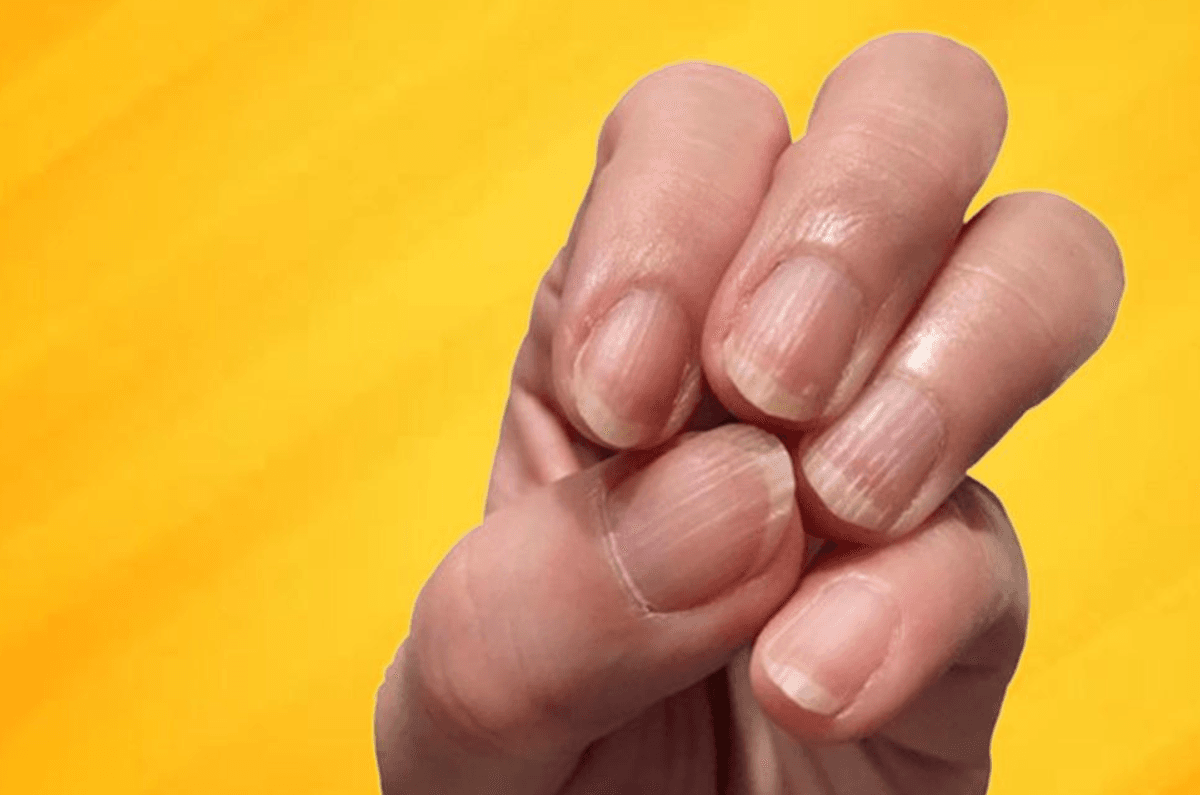 علت ایجاد خطوط عمودی و افقی روی ناخنها چیست؟