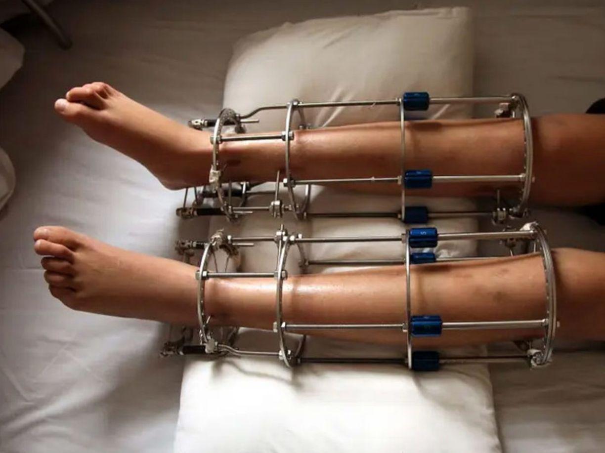 جراحی افزایش قد؛ مراحل جراحی افزایش قد چگونه است؟